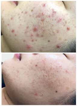 アンジェロ/【ニキビケア】肌育プログラム