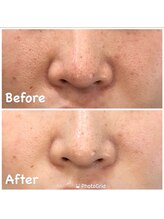 ココ(Coco)/毛穴洗浄