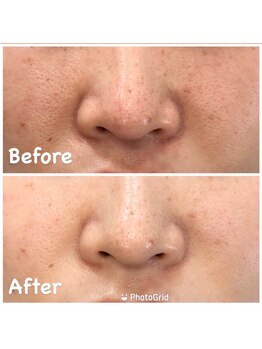 ココ(Coco)/毛穴洗浄