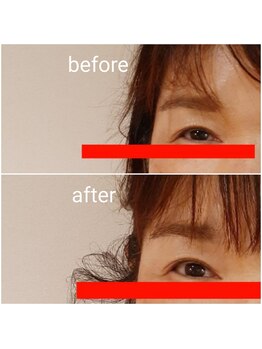 エルアンドエス(L&S)/目尻のラインのビフォーアフター