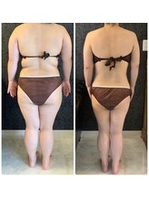 ミカ ネスト(Mika Nest)/カッピング(吸い玉)