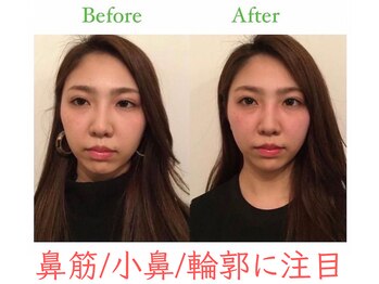 ラプリ 福岡天神店(Raplit)/隆鼻+輪郭・小顔矯正 美鼻/小顔