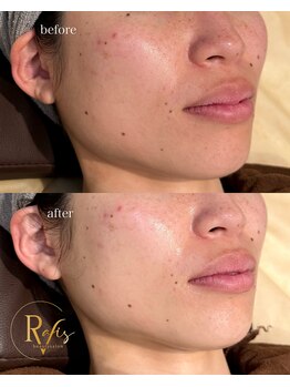 ラヴィス(RAVIS)/韓国肌管理ラミネーションピール