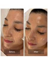 マインエム(mine.m)/刺さないリジュラン導入