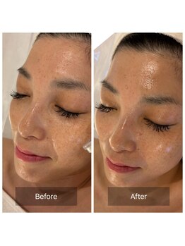 マインエム(mine.m)/刺さないリジュラン導入