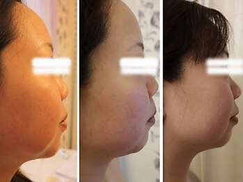 ニコリ(NICOLI)/レモンボトル　症例