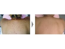 エムティーサロン(Mtsalon)/夏シミは冬に消し去るのが鉄則！