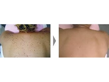 エムティーサロン(Mtsalon)/夏シミは冬に消し去るのが鉄則!