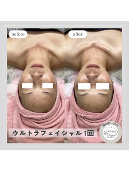 カラー(CALLA)/ウルトラフェイシャル