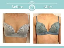 美人バスト 浜松店/◇ バストアップ &nbsp;BeforeAfter◇