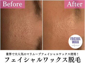 マイン(mine)/フェイシャルワックス脱毛