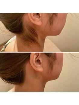 キュアーズ トータルビューティーサロン(CURES)/うなじ脱毛