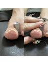 UPGELで巻き爪ケア