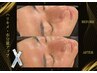 【エステ版ポテンツァ】ツヤハリ水光肌★スキンジェクション:HYALTIVE￥9,990