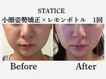 スターティス(STATICE)