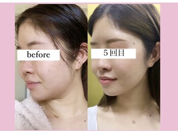 エムドット(M.)/毛穴洗浄