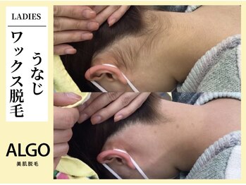 アルゴ 飯塚店(ALGO)/うなじワックス脱毛