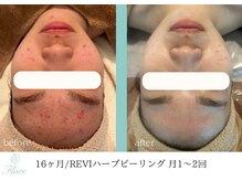 フローレ 平針店(Flore)/繰り返すお肌トラブルも改善