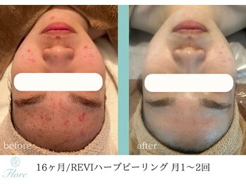 フローレ 平針店(Flore)/繰り返すお肌トラブルも改善