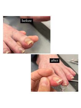 とくしま整体院 藍住院/一回で改善する巻き爪施術