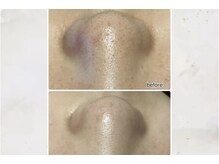 エンチャント(ENCHANT)の雰囲気(ハイドラ毛穴洗浄でつるつるモテ艶肌)