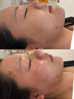 マホロバ(mahoroba)/ダーマ鍼最新美容鍼