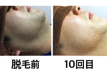 ノア(NOA.)/【効果重視のスピード施術】