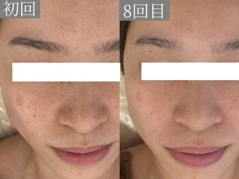 ホワイトアクア 鳳店(WHITE AQUA)/ララピール/大阪/鳳/毛穴/ツヤ肌