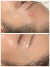 ピーナップ(P-nap)/肌、シミ改善50代