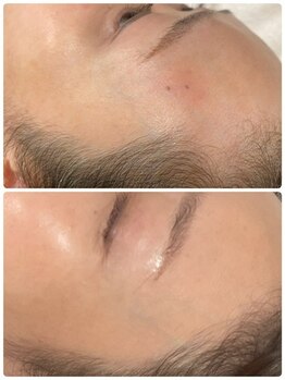 ピーナップ(P-nap)/肌、シミ改善50代