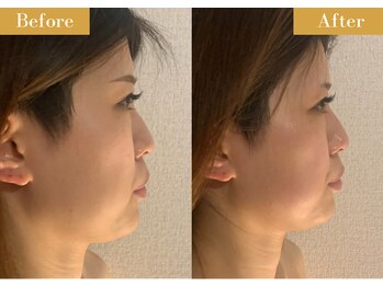 モモスパ(MOMOspa.)/頭蓋骨小顔矯正ビフォアフター