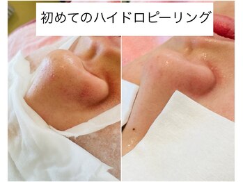 サロン ヴィーナス(VENUS)/ハイドロピーリング鼻回りの例