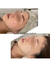 ウィズ(with)/REVIハーブピーリング×デコルテ