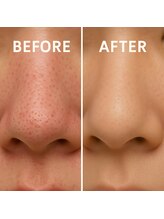 クリニカルエステクリア 梅田店/【毛穴開き×黒ずみ洗浄】