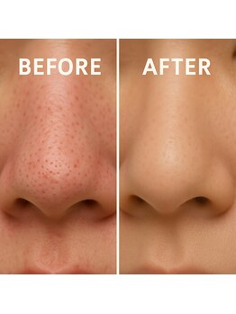 クリニカルエステクリア 梅田店/【毛穴開き×黒ずみ洗浄】