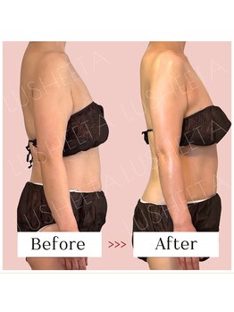 リュシータ 吹田千里丘店(LUSHEETA)/【 VENUS痩身 】(40代後半)