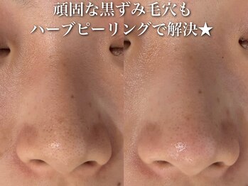 ホワイトアクア 梅田本店(WHITE AQUA)/ハーブピーリング/大阪/梅田