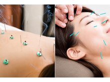 ハンズ鍼灸接骨院小牧院 美容整体ハンズ(美容整体hands)の雰囲気（ソフトな鍼灸施術で肩こり、腰痛、疲労回復♪美容鍼も相談下さい）