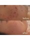ザヨン(Zayon)の写真/韓国式肌管理と美容鍼で理想のうるモチ美肌へ！乾燥小じわや肌荒れ予防や、肌の基礎から健やかに整える◎