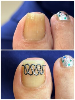 巻き爪矯正センター 沖縄 宜野湾/中度巻き爪矯正ビフォーアフター