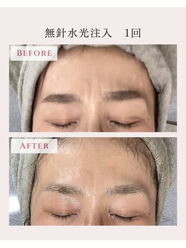 レクラ バイ ドクターエイチ(L'ECLAT by Doctor.H)/無針水光注入”美容液真皮導入”