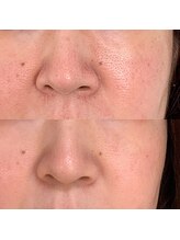 ウイユ(Oeil)/剥けるハーブピーリング 効果1回