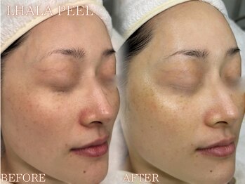 レイネ(REINE)/韓国肌管理★ララピール