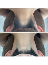 ミース 北九州店/うなじ△ビフォーアフター