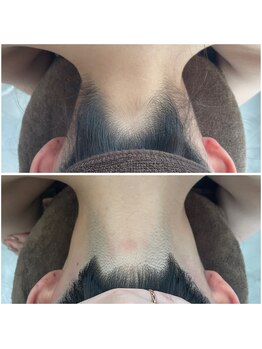 ミース 北九州店/うなじ△ビフォーアフター