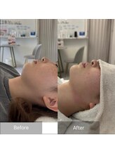 キレナル(KIRENAL)/レモンボトル