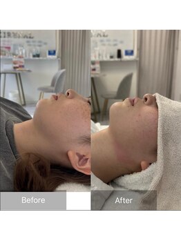 キレナル(KIRENAL)/レモンボトル