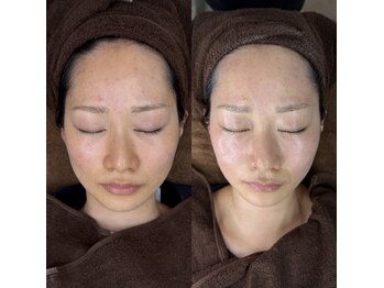 ECLA　塚口【黄土漢方よもぎ蒸し/毛穴/フェイシャル】の写真/【お肌悩みの相乗効果♪】本格黄土よもぎ蒸し×極上フェイシャルでお肌悩み改善◎毛穴/シミたるみ/肌荒れ