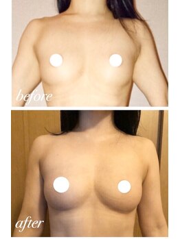 リール 新宿店(RIRE)/30代後半 バストアップ症例