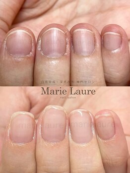 マリーロール 梅田店(Marie Laure)/深爪矯正/自爪育成/自爪風
